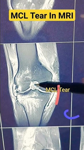 MCL Tear In MRI Film🔥 एमआरआई में लिगामेंट की चोट कैसे दिखती है | #ligament #kneeligament #kneejoint