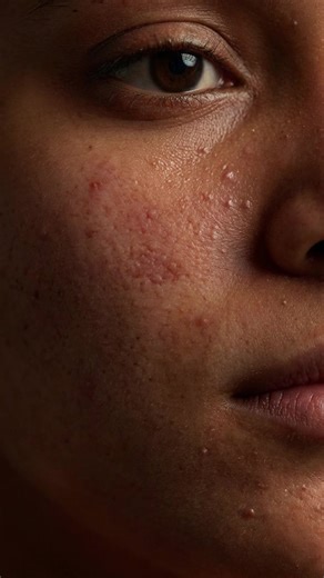 Packed schedules don’t leave your skin time to recover – daily stress weakens your skin barrier and invites breakouts. Keep it simple, consistent, and protected with Acnestar. (Daily stress & skin, Skin barrier protection, Busy lifestyle skincare, Acne-prone skin care, Breakout prevention, Consistent skincare routine, Gentle acne care, Barrier repair, Everyday skin protection, Stress-related breakouts) #Acnestar #AcneCare #AcneProneSkin #SkinBarrier #BarrierCare #BreakoutControl #HealthySkinRout