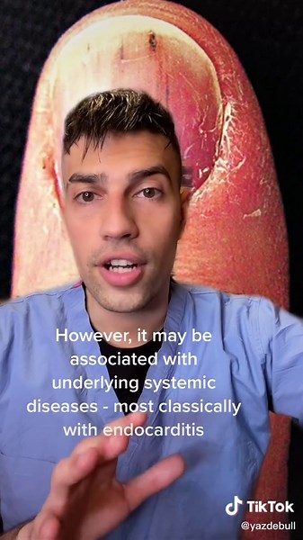 Understanding Splinter Hemorrhage of the Fingernails