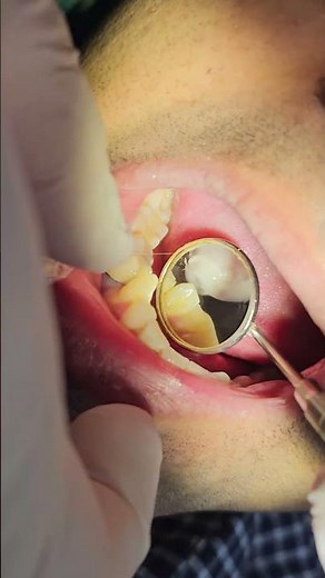 Porclein fused to metal Crown placement