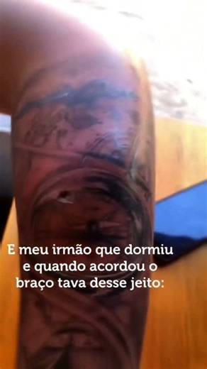 Acordou com braço inchado por picada de aranha!! 🫢🕷️