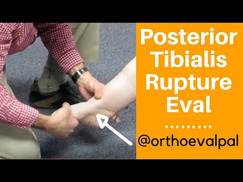 Posterior Tibialis Rupture Evaluation