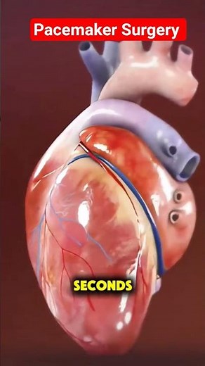 How Pacemaker Surgery is done!