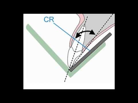 Bisecting Angle Technique (TIPS)