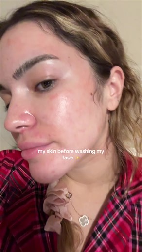 Acne Skin Transformation: Before and After Washing