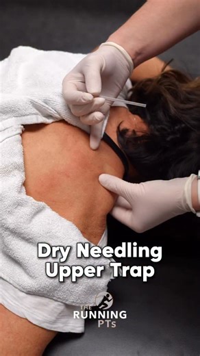 The Running PTs | Running Injury Specialists on Instagram: "Dry Needling for Runners 📍Come see us in Wake Forest, NC Cary • Apex • Raleigh 📞 (919) 803-3398 ✉️ Info@TheRunningPTs.com #raleighphysicaltherapist #pt #runner Physical Therapy in Wake Forest"