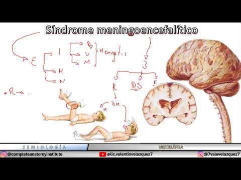 Síndrome meningoencefalítico | Signo de Kernig, Signo de Brudzinski, Opistótonos