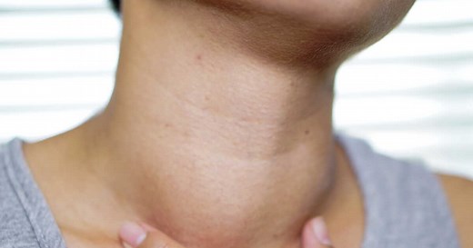Goitre thyroïdien : causes, symptômes et traitements pour le faire disparaître