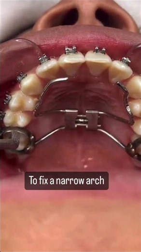 A narrow upper jaw can affect more than just your smile