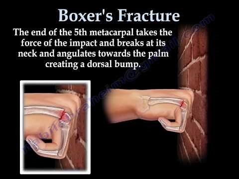 Boxer's Fracture - Everything You Need To Know - Dr. Nabil Ebraheim
