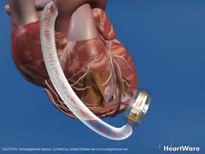 HeartWare HVAD Left ventricular Assist Device