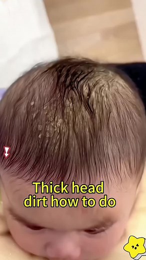 Baby Scalp Cleaning Brush for Newborns - How to Remove Dandruff Safely