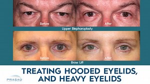 Treatments for Hooded Eyelids, and Heavy Eyelids