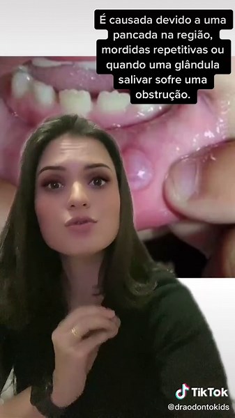 O que é Mucocele? Sintomas, Causas e Tratamentos