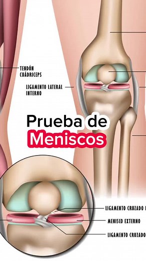 La prueba de McMurray es comúnmente utilizada para evaluar la posibilidad de una lesión en los meniscos de la rodilla. La presencia de un chasquido o clic durante esta prueba, especialmente en combinación con dolor, puede indicar una lesión de menisco. Sin embargo, se requiere una evaluación completa, que incluya otras pruebas clínicas y posiblemente estudios de imagen, para confirmar el diagnóstico. Es importante que esta prueba sea realizada por un profesional de la salud capacitado y en el co