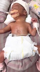 Extremely LWB baby WT 1kg on ventilator 🙏 reflex good #newbron #NewbornCare #newbornbabies | Babies videos