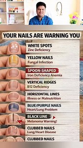 Your hands & nails can reveal a lot about your overall health. ❤️‍🩹Here’s a general guide to understand what your nails might be telling you! 🛑Iron Deficiency Spoon-shaped nails (koilonychia) are a specific sign of iron deficiency. Other symptoms: anemia, extreme fatigue, weakness, pale skin, shortness of breath & dizziness 🩺Increase your intake of iron-rich foods such as red meat, beans, and leafy green vegetables. It’s important to identify and treat the underlying cause of the deficiency,