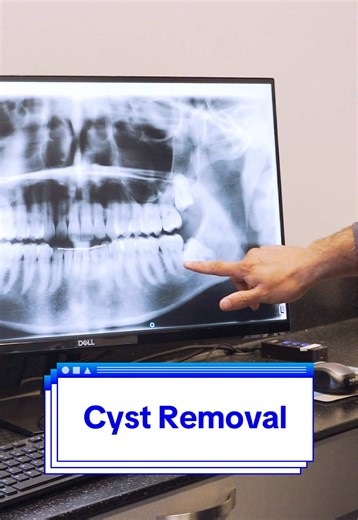 Cysts are not the same as tumors, and it's important to know how to prevent them when dealing with impacted wisdom teeth. When your wisdom teeth are impacted, the sac they are growing in (called a follicle) can get trapped and form a cyst which can prove to be a real pain to affected patients. #oralsurgery #dentist