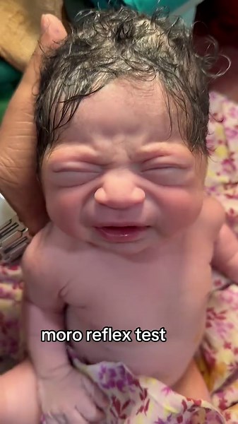 moro reflex for examination neonatal nervous system #mororeflex #drataurrahman #caesar