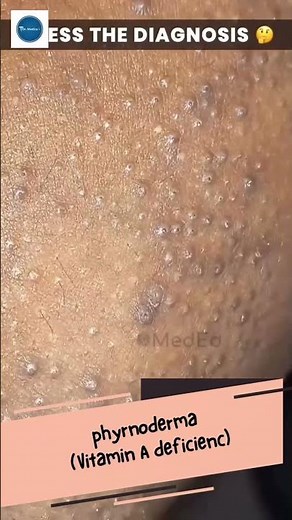 Dr Medica Clinical Cases || Pyrnoderma || Rear Medical Diseases || Clinical medicine||