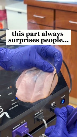No scissors, no scalpels…. Just RF! #labiaplasty #rflabiaplasty #radiofrequency #rf #womenswellness