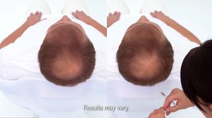 If you want thicker hair, quickly and conveniently—try Xtrands®! It’s a volumizing hair loss solution that adds fullness and density to your thinning hair without the need for surgery. Best of all, Xtrands gives you instant results! Visit hairclub.com to book your free consultation and see if Xtrands is right for you. | HairClub