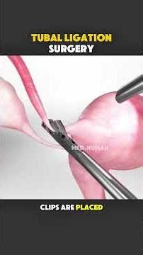 Tubal Ligation Surgery (3D Animation)#3danimation #medicaleducation #healthcare #fyp