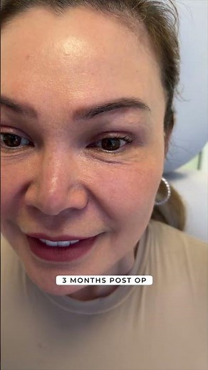Before and after endoscopic brow lift and upper blepharoplasty.