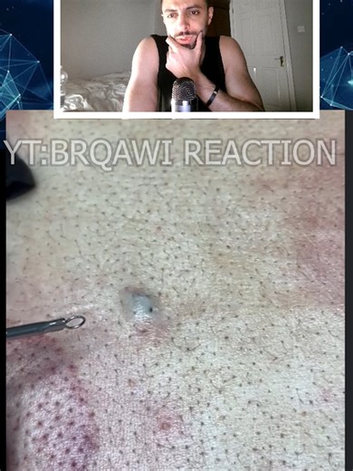 Effective Blackhead Extraction Techniques for Clear Skin