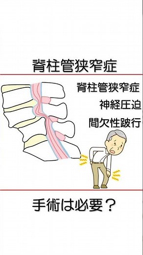 脊柱管狭窄症 危険な症状！ 痛みの原因は？ 【医師が解説】 #坐骨神経痛 #脊柱管狭窄症 #椎間板ヘルニア