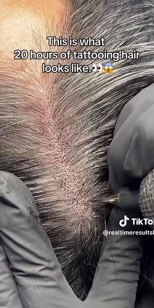 Scalp Micropigmentation: Hair Tattoo for Women