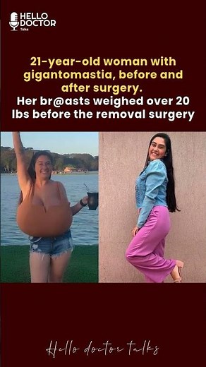 21-year-old woman with gigantomastia, before and after surgery #healthchannel #doctorslife #askdoc