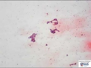 Thyroid cytology - Follicular neoplasm
