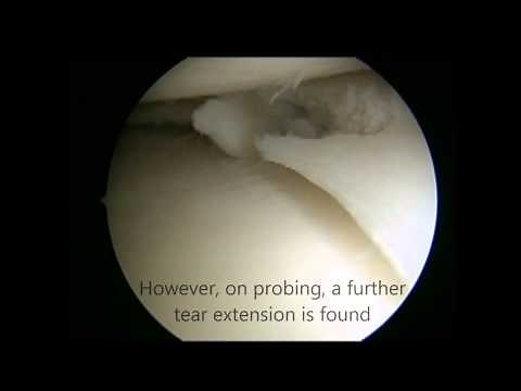 Knee Meniscal Tear Treatment - Keyhole Surgery (Arthroscopy)