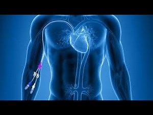 PICC LINE ( Peripherally inserted Central catheter) INSERTION Dr Anurag Aggarwal MD, DA, FIPM, PDCC