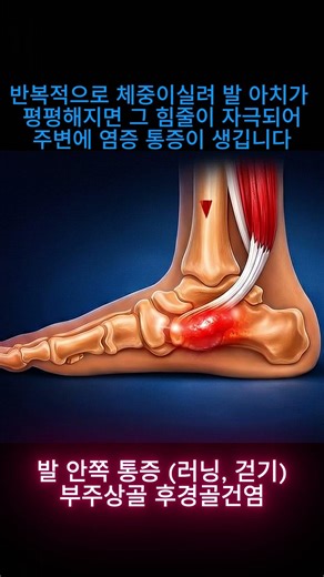 발 발목통증(러닝 걷기) 부주상골, 후경골건염 #러닝 #physiotherapy #러닝부상 #러닝스타그램 #부주상골 #발통증 #발목보조기 #발목염좌 #발목