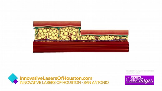18 reactions | Great Day SA visited with Innovative Lasers Of Houston...