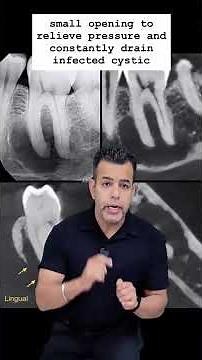🦷 Non-Surgical Management of Large Periapical Lesions | Decompression Technique #delhidentist
