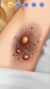 Huge Underarm Cyst Popped! Satisfying Deep Cleaning Treatment | Ap Pop Relief ASMR
