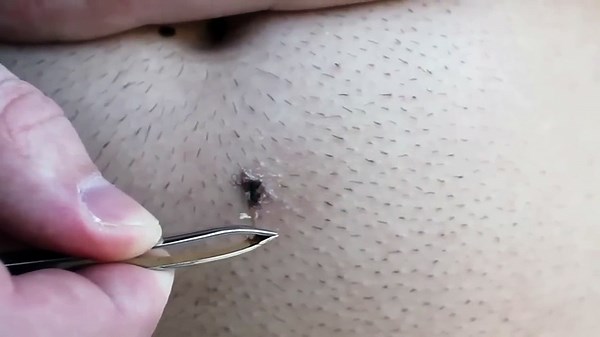 Longest ingrown hair removal below belly button