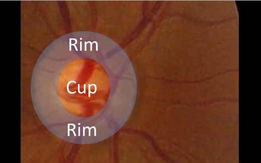 【中英双字】【视盘检查】Optic Disc Apperance