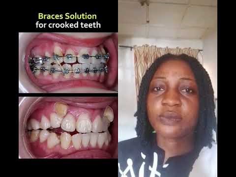 Best solution for crooked teeth #dentist #orthodontist #dentalprosthesis