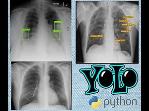 YOLO11 for Lung Cancer Detection | Early Lung Cancer Detection