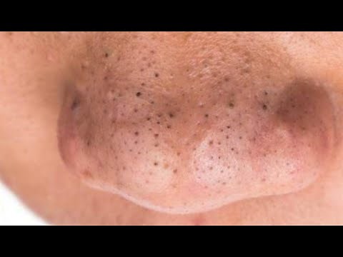 Reventando Granitos o espinillas Gigantes ---- Popping Giant Pimples or Pimples