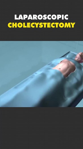 Laparoscopic Cholecystectomy Surgery 3D Animation #cholecystectomy #cholecystitis #cholecystectomyrecovery #cholecystectomy💉📚🏥 #cholecystectomyproblems #cholecystitis? #laparoscopicsurgery #laparoscopiccholecystectomy #medical3danimation #3dmedicalanimation