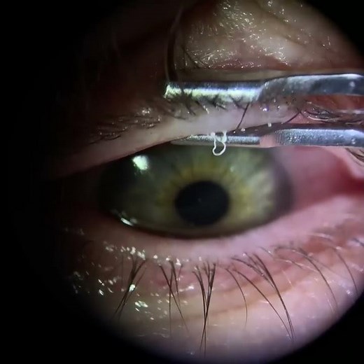 Meibomian Gland Expression