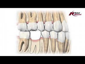Consequences of missing teeth