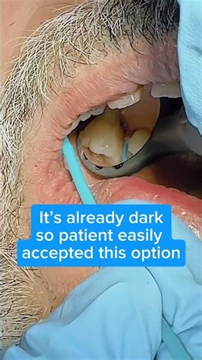 Let’s SDF-IT (a silver diamond fluoride case)