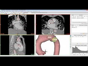 Tutorial: Mimics Innovation Suite - Centerline Tool