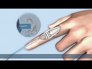 CapFlex PIP – Endoprosthetic treatment of the proximal interphalangeal joint Dorsal approach 1